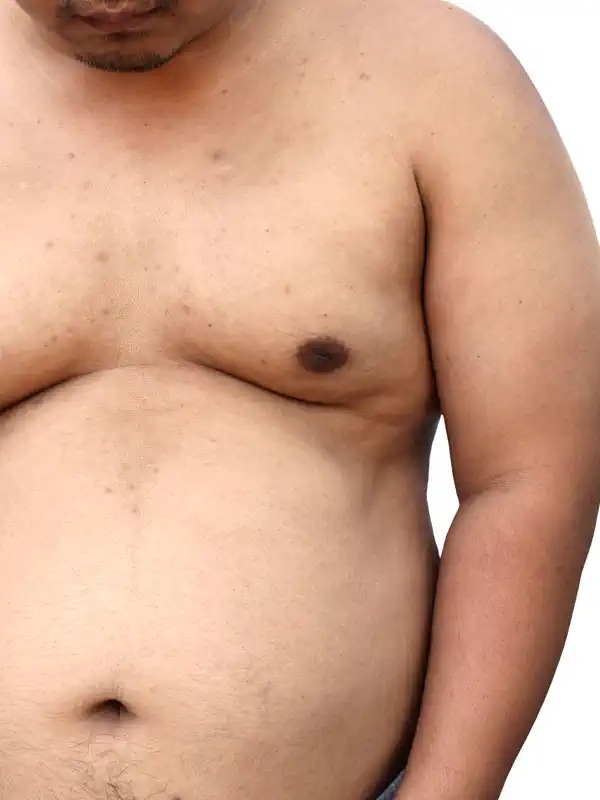 Gynecomastia Gynecomastia